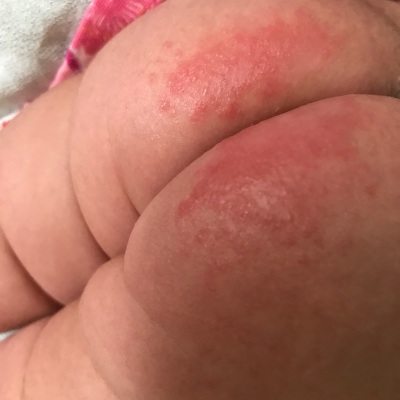 宝宝红屁股怎么处理的,宝宝红屁股反反复复怎么办