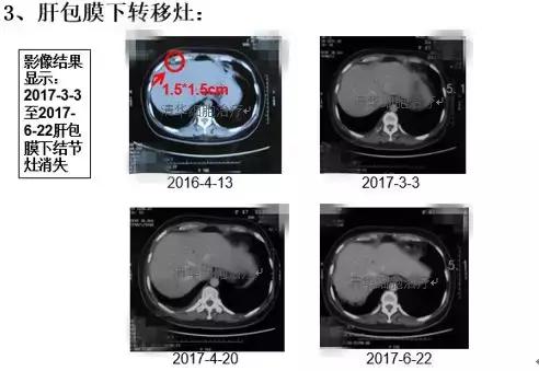 肺腺癌晚期nkt细胞免疫治疗价格,肺癌晚期nk细胞疗法