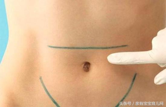 剖腹产横切好还是竖切好？原来有这么多缝合方式，你是属于哪种？