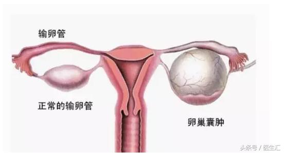 肚子绞痛并且鼓包怎么回事,卵巢囊肿腹痛说明破裂了吗
