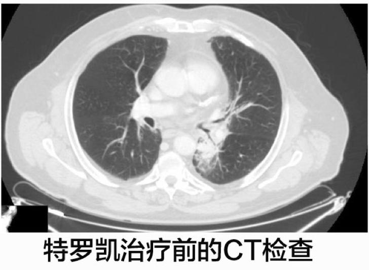 案例：化疗失败的EGFR阴性肺腺癌使用特罗凯病灶完全消失