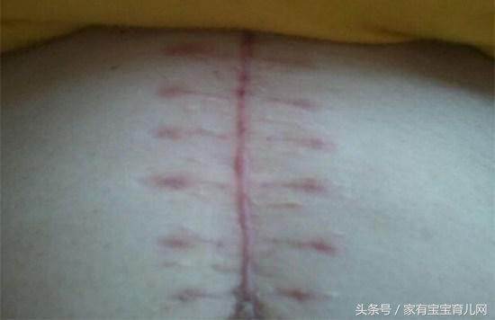 剖腹产横切好还是竖切好？原来有这么多缝合方式，你是属于哪种？