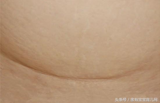 剖腹产横切好还是竖切好？原来有这么多缝合方式，你是属于哪种？