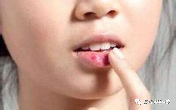 妇科上火什么方法有效降火,女性易上火咋调理