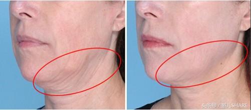 一次超声刀=1000张面膜，你敢说不好吗？