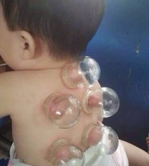 初学者怎样学拔火罐详细视频,拔火罐具体步骤操作口诀