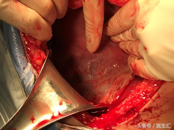 产科疑难病例超声会诊,孕期前置胎盘子宫肌瘤怎么处置