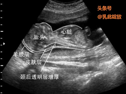 孕早期nt检查最佳时间,孕早期nt怎么看