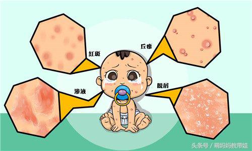 婴儿面部湿疹怎么护理效果最好,新生儿湿疹可以用黄金菊护理膏吗