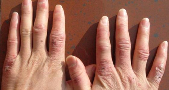 护手干裂小偏方,天气冷手干裂用什么护手霜