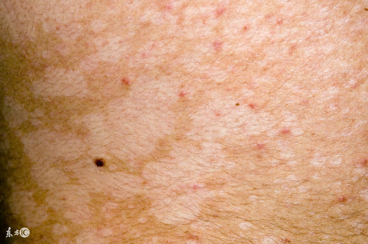 治疗花斑癣的最好方法,治疗花斑癣最快最有效的方法