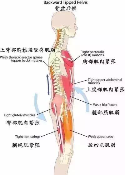 骨盆后倾的自我矫正方法,骨盆后倾怎样自己矫正
