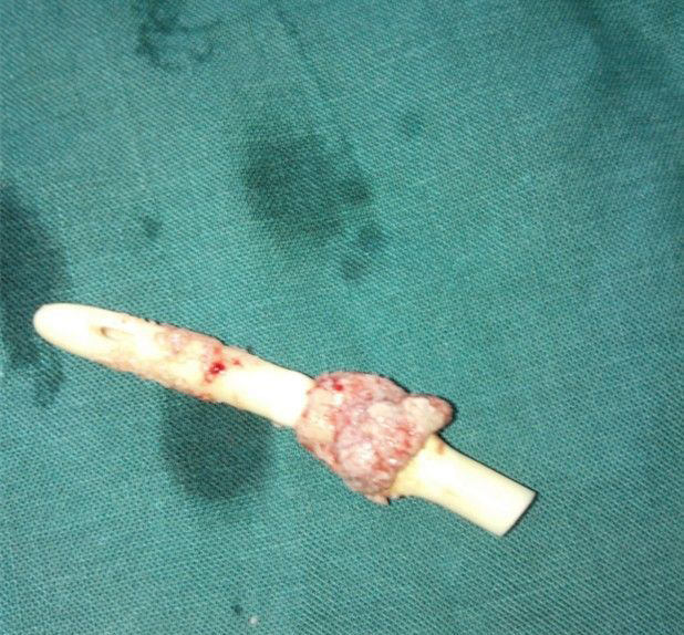 尿管怎么卡住,尿管怎么卡住不让尿液流出