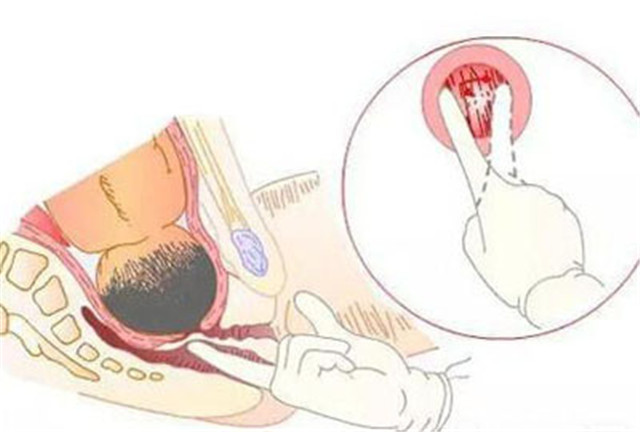 生产开几指就快生了,生产时怎么检查开了几指