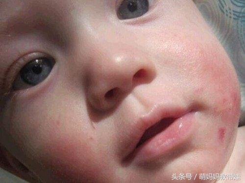 婴儿面部湿疹怎么护理效果最好,新生儿湿疹可以用黄金菊护理膏吗