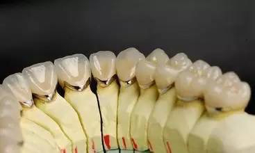 镍铬烤瓷牙全瓷牙价格,镍铬烤瓷牙与钴铬烤瓷牙怎么选