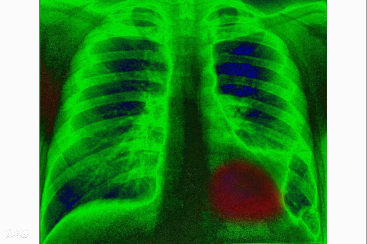 阿奇霉素能治疗急性支气管炎吗,孩子急性支气管炎怎么治疗好得快