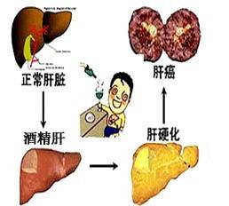 酒精肝症状表现及治疗,酒精肝的并发症有哪些