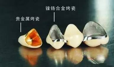 镍铬烤瓷牙全瓷牙价格,镍铬烤瓷牙与钴铬烤瓷牙怎么选