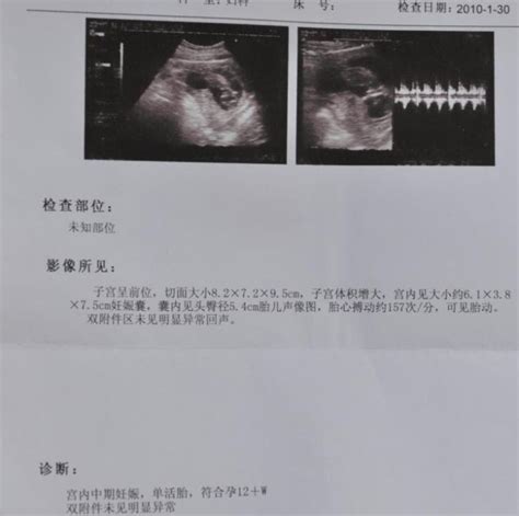 b超对子宫有损伤吗,超声波与b超有区别吗
