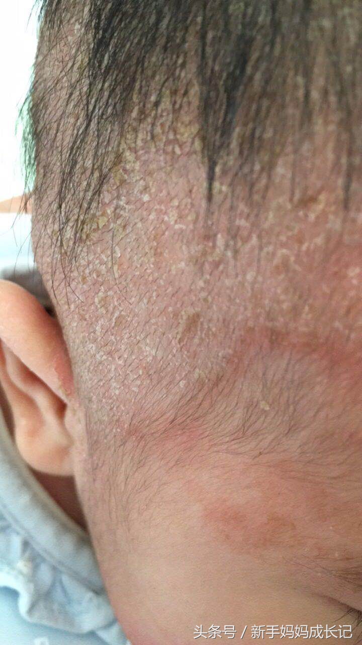 宝宝湿疹的样子有哪些,宝宝湿疹的前期症状是怎样的