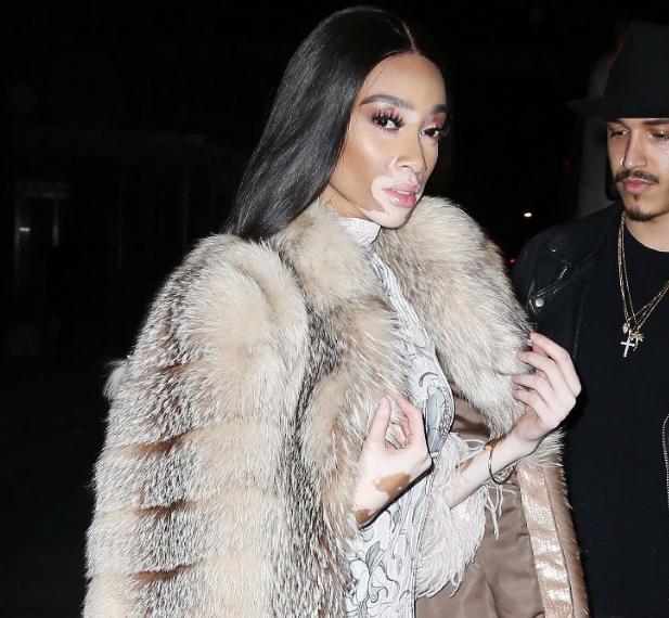 全世界公认的超模,最漂亮的白癜风超模