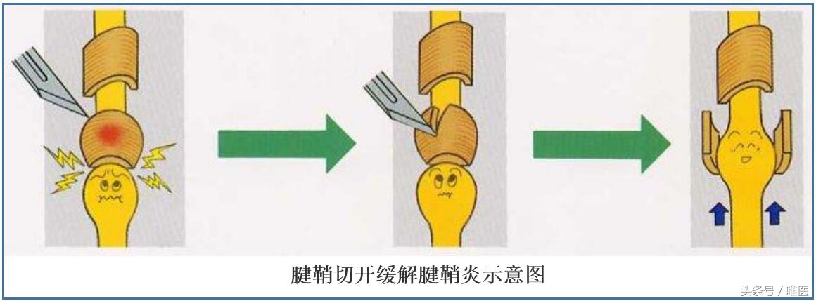 腱鞘炎治疗过程疼到尖叫视频,腱鞘炎跳一跳