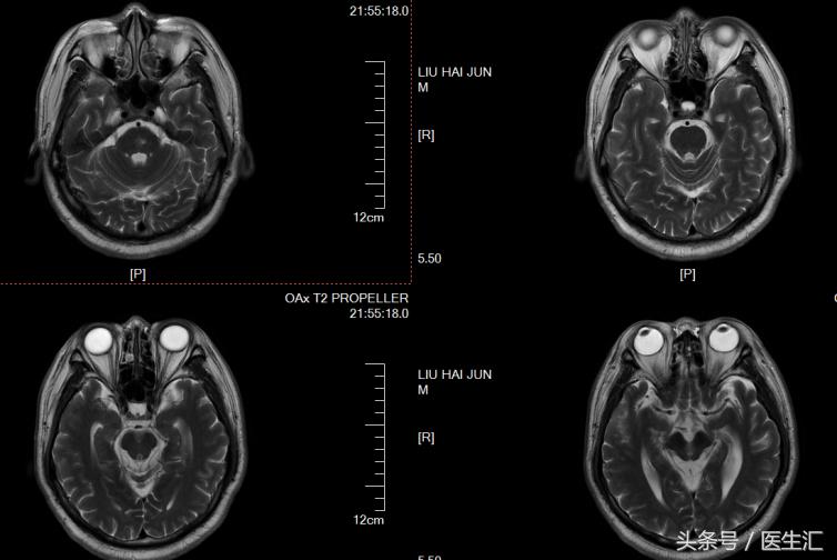 进行性核上性麻痹综合征,进行性核上性麻痹存活寿命