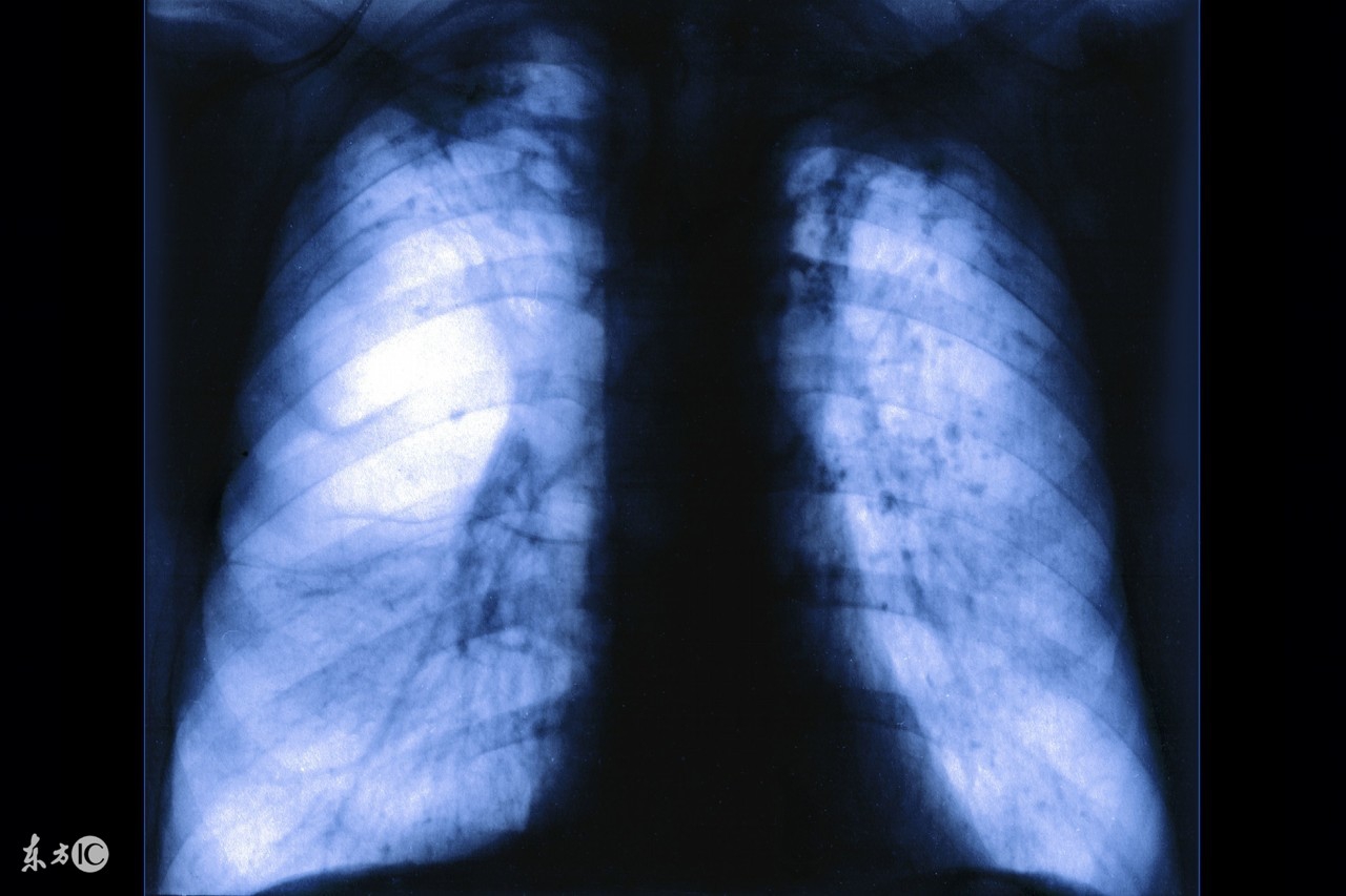 老人肺气肿要怎么去治疗,老年人肺气肿怎么保健