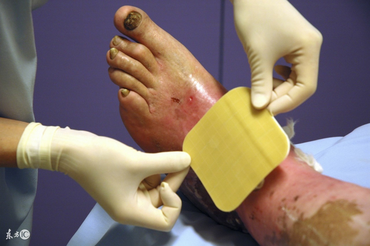 糖尿病足一级溃烂最佳治疗方法,中医治疗糖尿病足溃烂用什么药