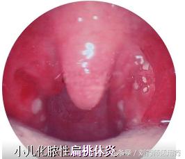 人类发现的第一个抗生素,现在临床还能用吗?