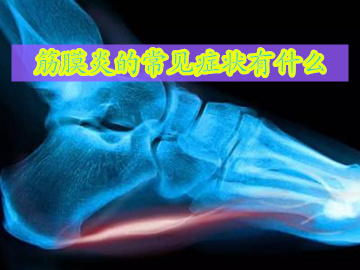 筋膜炎症状表现有哪些,筋膜炎发病以后多长时间能自愈