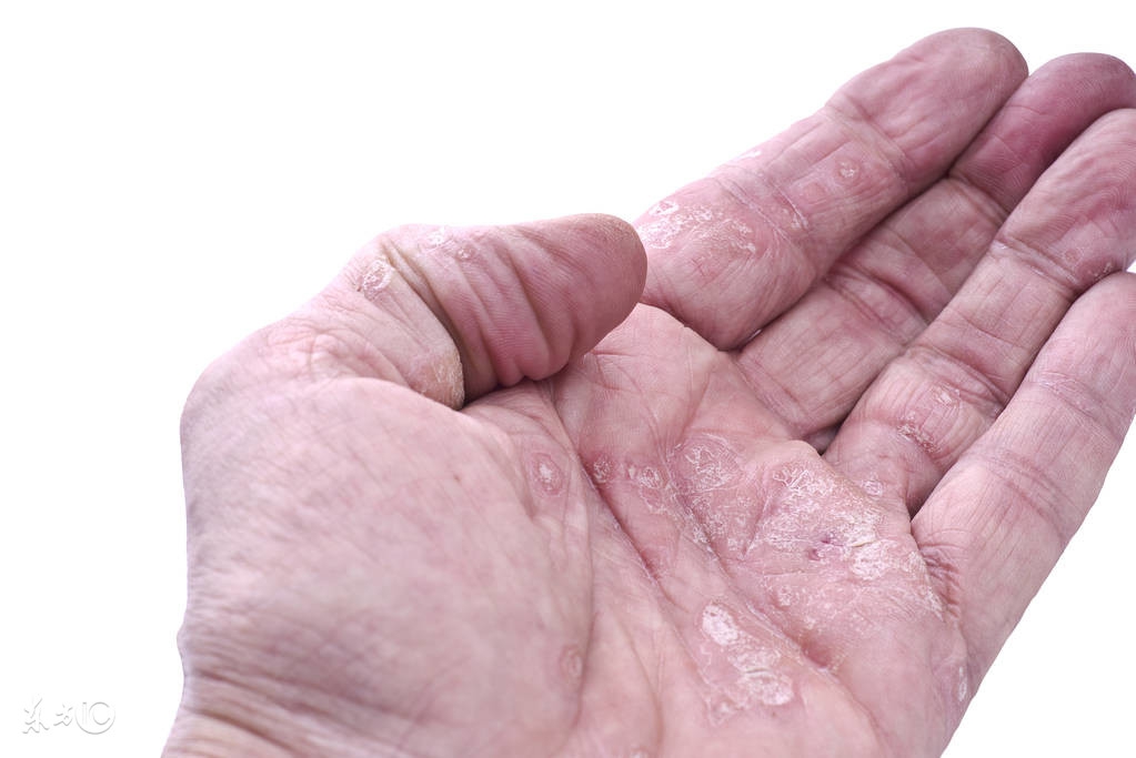 治银屑病的五种软膏,达克宁能治疗银屑病吗