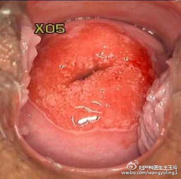 治疗“宫颈糜烂”，这个药被滥用了很多年