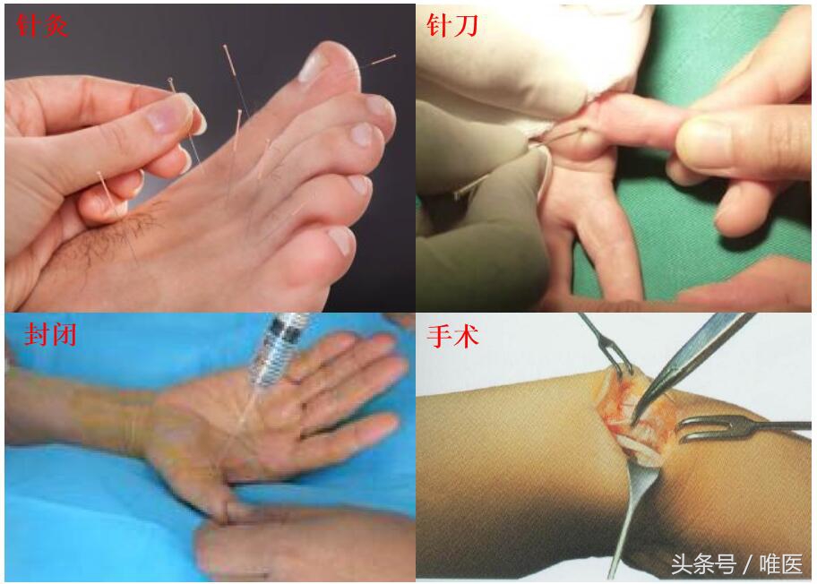 腱鞘炎治疗过程疼到尖叫视频,腱鞘炎跳一跳