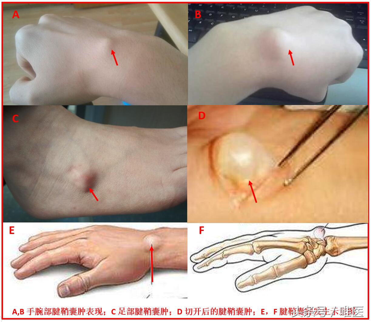 腱鞘炎治疗过程疼到尖叫视频,腱鞘炎跳一跳