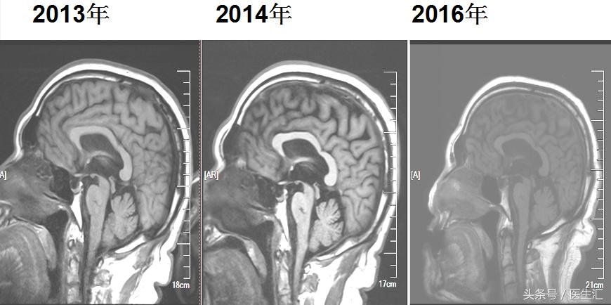 进行性核上性麻痹综合征,进行性核上性麻痹存活寿命