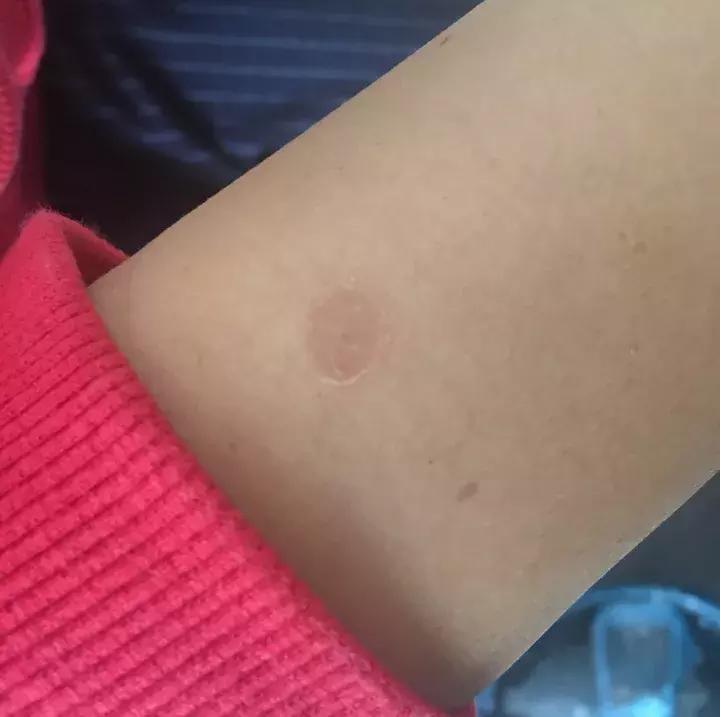 治疗猫癣过程注意什么,猫咪预防猫癣用什么药比较好