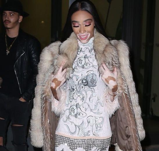 全世界公认的超模,最漂亮的白癜风超模