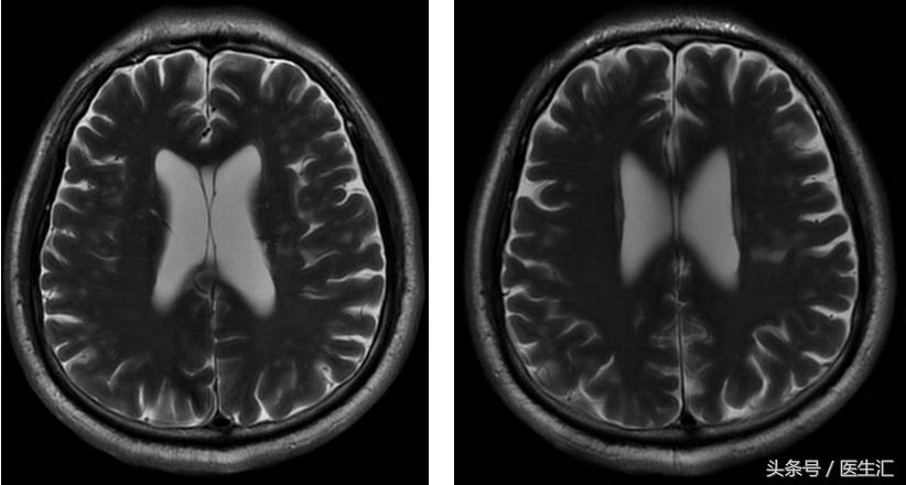 进行性核上性麻痹综合征,进行性核上性麻痹存活寿命