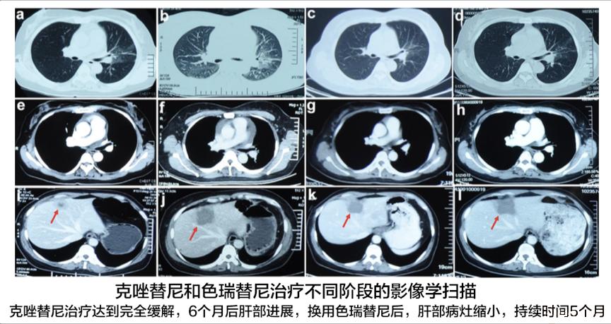 alk阳性肺癌耐药成功案例,肺癌alk阳性晚期能痊愈吗