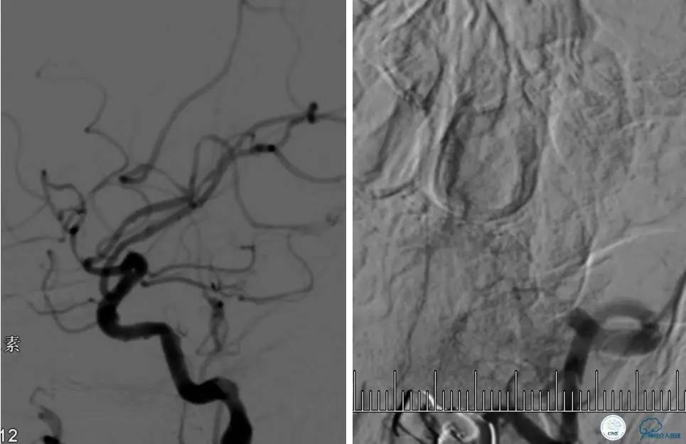 颅内动脉狭窄介入治疗研究,颅内血管cta副作用