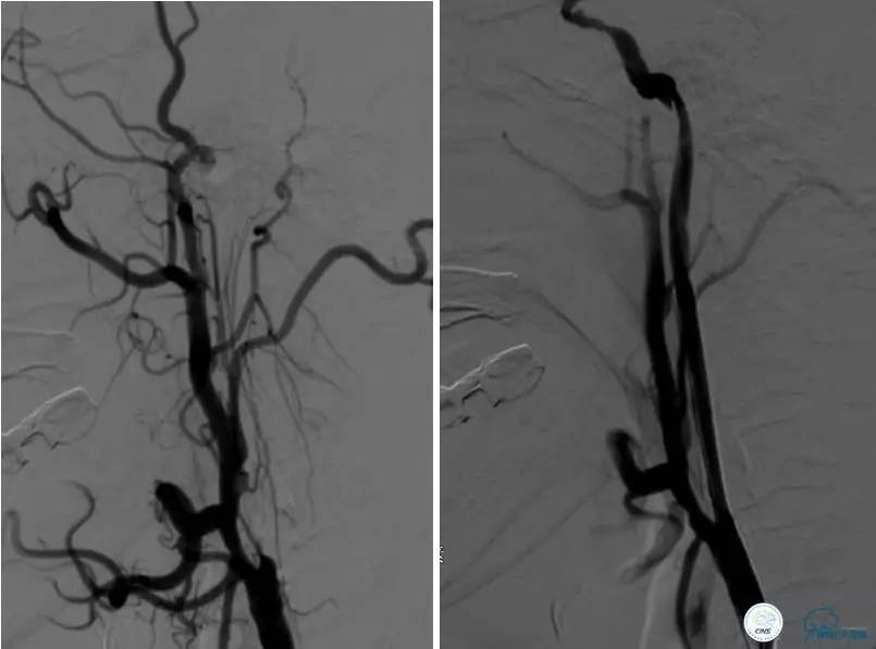 颅内动脉狭窄介入治疗研究,颅内血管cta副作用