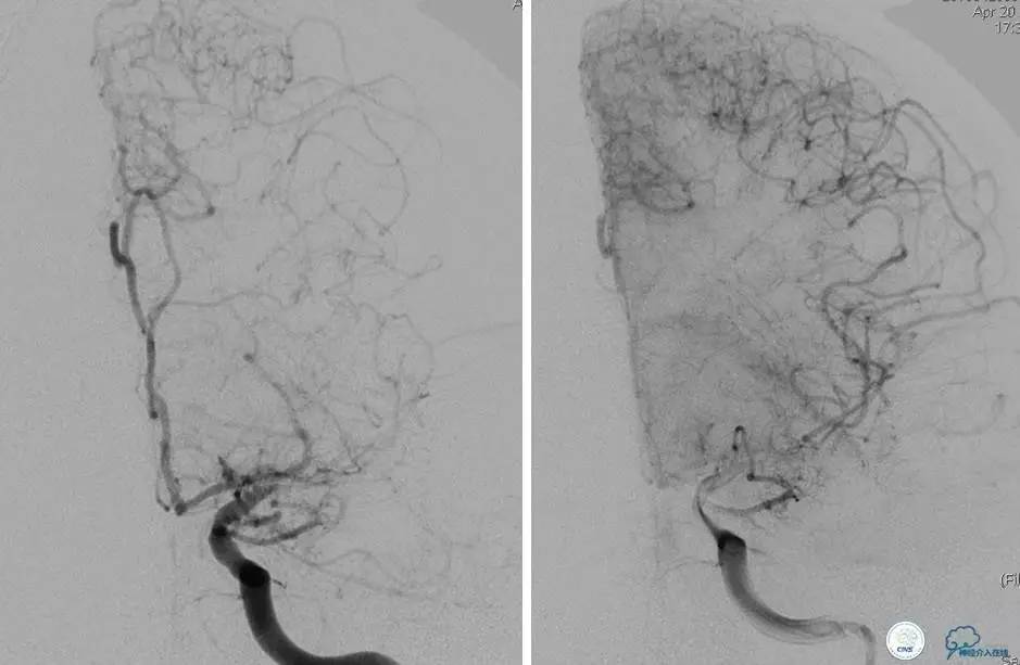 颅内动脉狭窄介入治疗研究,颅内血管cta副作用