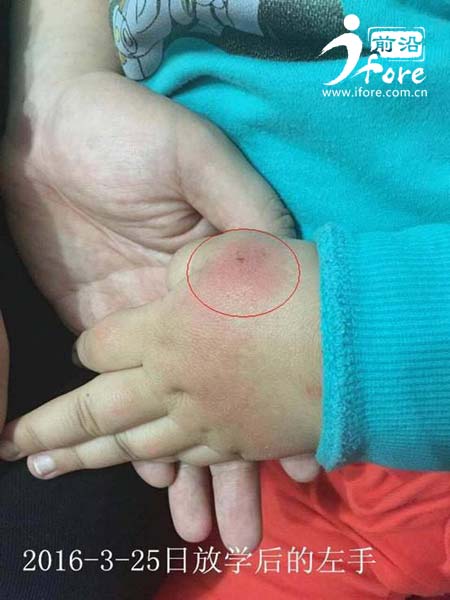 塔元庄幼儿园老师针扎幼童,红黄蓝幼儿园针扎幼童