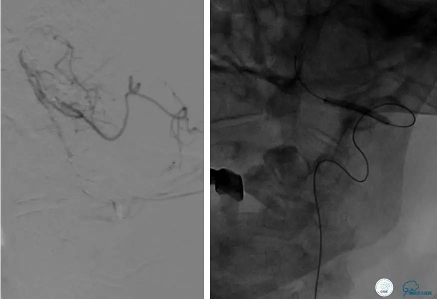 颅内动脉狭窄介入治疗研究,颅内血管cta副作用