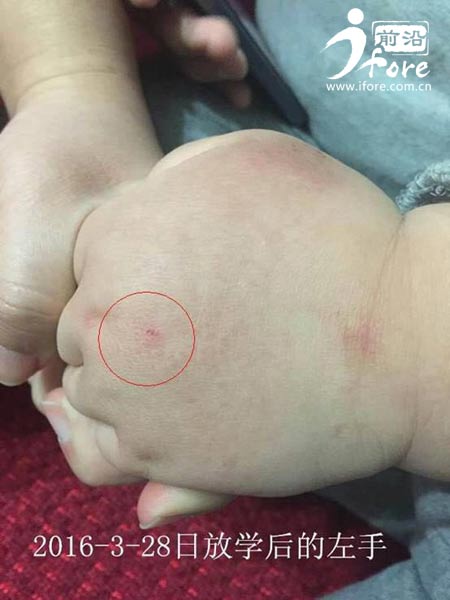 塔元庄幼儿园老师针扎幼童,红黄蓝幼儿园针扎幼童