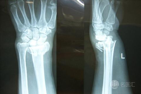 小朋友骨折怎么安慰家长,儿童骨折受伤了怎么安慰