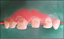 前牙光固化美容修复的方法,乳前牙预成冠修复过程