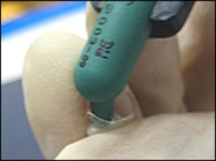 前牙光固化美容修复的方法,乳前牙预成冠修复过程